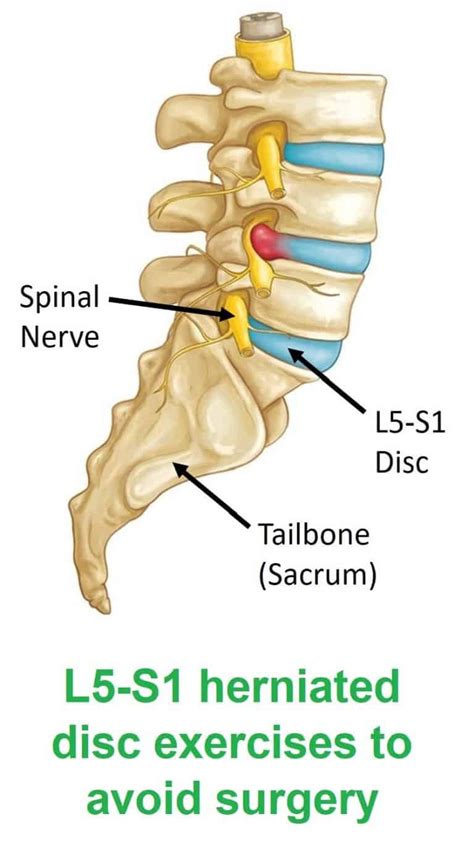 L5-S1 Herniated disc relief with 3 exercises to avoid surgery