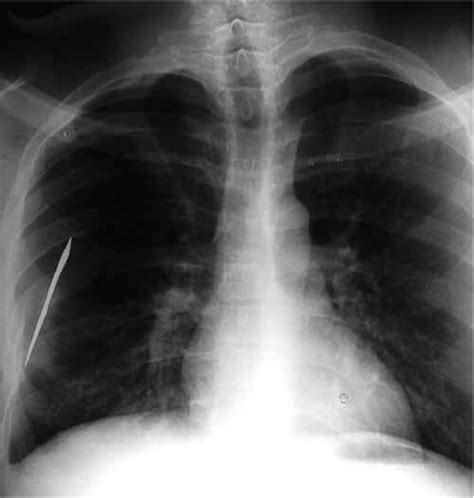 Anterior-posterior chest X-ray prior to surgery | Download Scientific ...