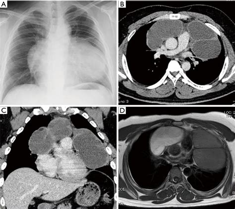 Surgical resection of a giant polycystic seminoma of the mediastinum - Goto - Journal of ...