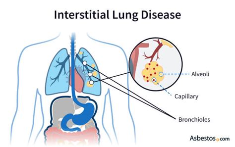 Types Of Interstitial Lung Disease (ILD), 45% OFF