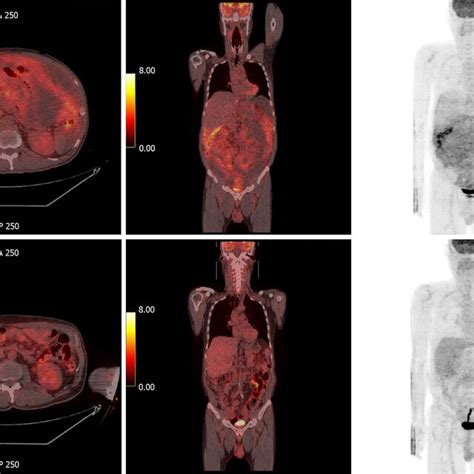 Positron emission tomography-computed tomography. A: Positron emission ...