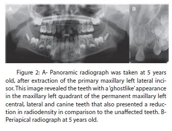 MANAGEMENT AND RADIOGRAPHIC FEATURES OF A RARE CONDITION: REGIONAL ODONTODYSPLASIA IN PRIMARY ...