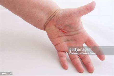 36 What Is A Puncture Wound Stock Photos, High-Res Pictures, and Images - Getty Images