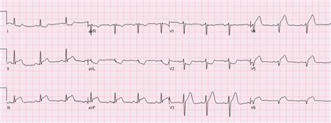 The Importance of Reciprocal Changes in aVL - REBEL EM - Emergency Medicine Blog