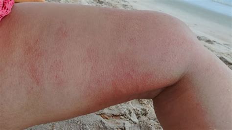 More than 800 people were stung by jellyfish along Florida beaches in three days | CNN