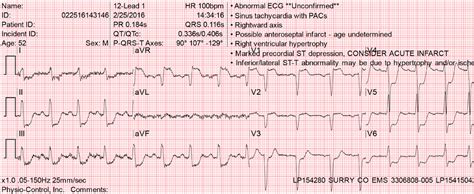 Dr. Smith's ECG Blog: Diffuse Subendocardial Ischemia on the ECG. Left main? 3-vessel disease? No!