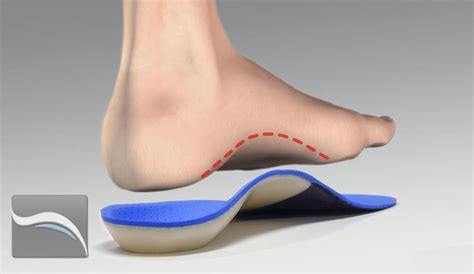 Foot Supination Orthotics at Edward Corey blog