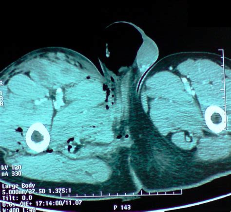 CT showing a right scrotal Pneumatocele. | Download Scientific Diagram