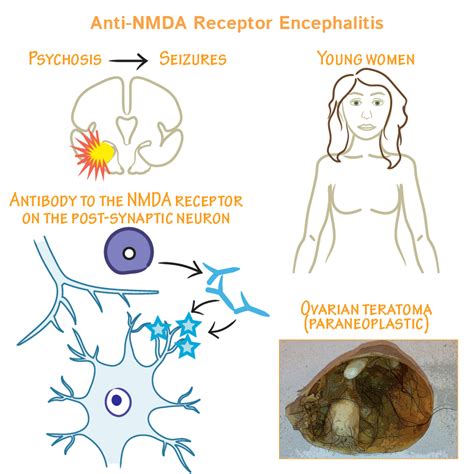 Neurological System Glossary: Anti-NMDA Receptor Encephalitis | ditki medical & biological sciences