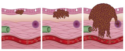 Metastasis - Answers on HealthTap