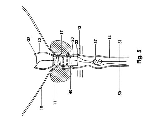 Patent US8465551 - Temporary prostatic stent for benign prostatic ...