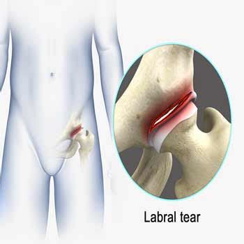 Hip Labral Tear Nashville | Traumatic Injury Franklin | Hip Arthroscopy Brentwood