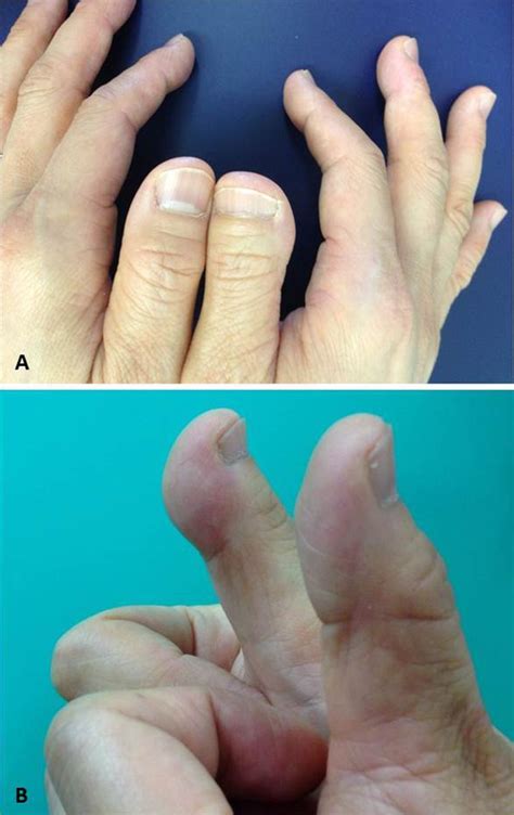 Non-syndromic brachydactyly, known as Shamoji-yubi or Mamushi-yubi in ...