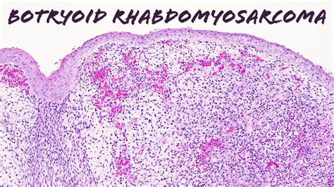 Botryoid embryonal rhabdomyosarcoma: Basic soft tissue pathology ...