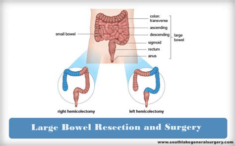 Large Bowel Resection Surgery and Recovery - Southlake General Surgery