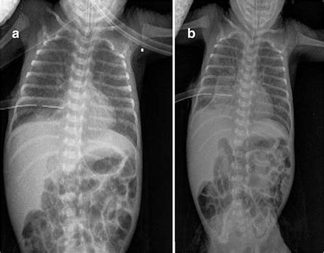 Fibrin glue pleurodesis for pneumothorax in extremely preterm infants ...