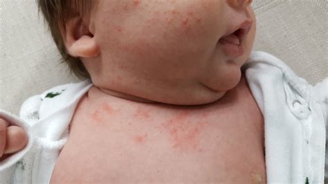 Is this a rash or baby acne on his chest? (Pic included) - BabyCenter