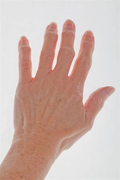 Finger Arthritis: Signs, Symptoms, and Treatment