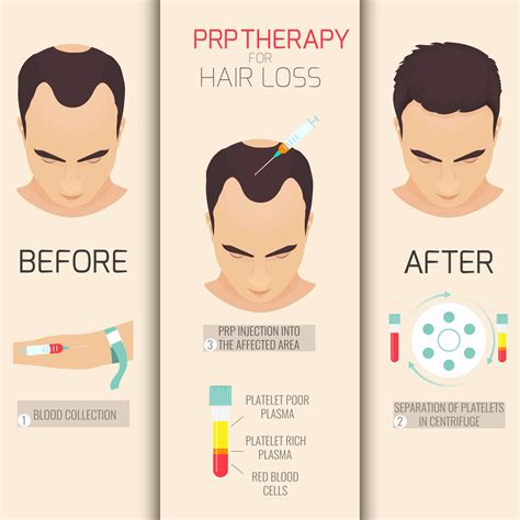 PRP Therapy as Hair Loss Treatment | KL Aesthetic | Malaysia