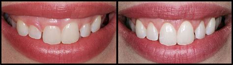 Cosmetic Dentistry Before & After Case Studies | Bunker Hill Dentistry | Houston, TX