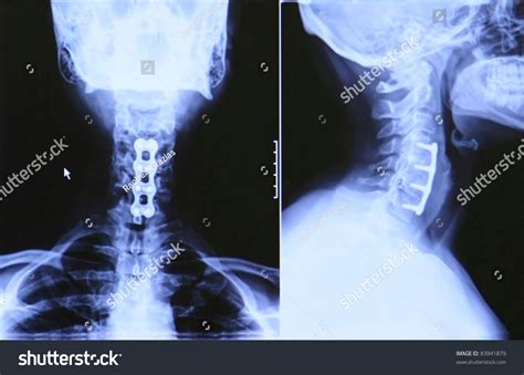 Cervical Neck X-Ray Stock Photo 83941879 : Shutterstock