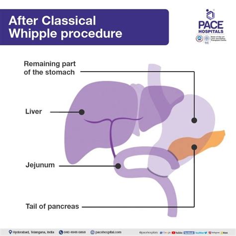 Best Hospital for Whipple Procedure in Hyderabad | Surgery and Cost