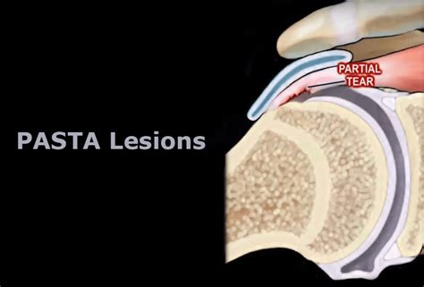 PASTA Lesions | Shoulder Dislocation Treatment, Bangalore