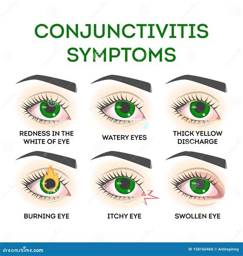 Conjunctivitis Vector Illustration | CartoonDealer.com #41301816