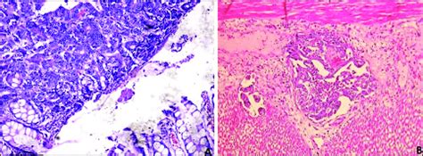 Histology of rectal adenocarcinoma in dogs. A-The rectal mucosa... | Download Scientific Diagram