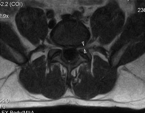 Axial MRI demonstrates minor thecal sac compression and left ...