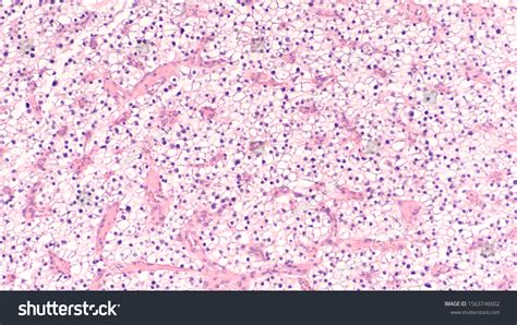 Microscopic Image Showing Histology Parathyroid Adenoma Stock Photo (Edit Now) 1563746602