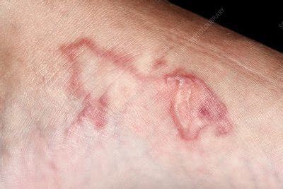 Cutaneous larva migrans infection - Stock Image - C042/6356 - Science Photo Library