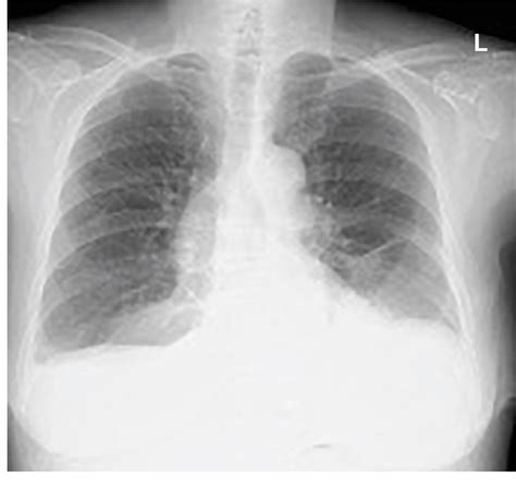 Figure 6 from A Case of Pneumothorax Ex Vacuo Associated with COVID-19 ...