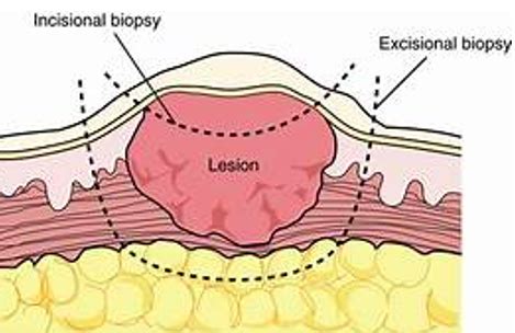 Biopsy techniques Flashcards | Quizlet