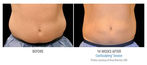 Men's Coolsculpting Before & Afters | Torrance Med Spa | Coolsculpting Torrance | Botox Laser ...