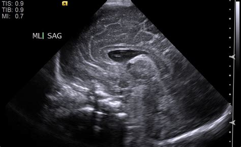 Ultrasound Neonatal Brain | Radiology Template Reports