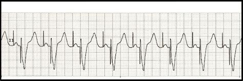 Float Nurse: EKG Rhythm Strip Quiz 100: Paced rhythms