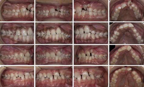 Orthodontic Treatments In Cleft Lip & Palate Patients - Oral Health Group