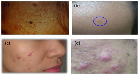 Clinical features of acne vulgaris. (a) Acne type 1 lesion (b) Acne ...