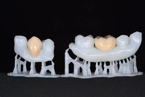 3D Printed Teeth on the Form 1+ Help Dentists and Patients Prepare for Dental Procedures ...