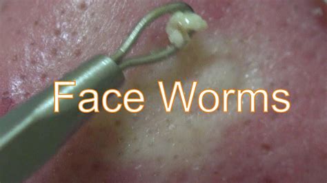 Face Worms | Life With Cystic Acne Documentary #33 - YouTube