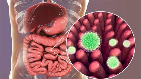 Leaky Gut & Autoimmune Diseases