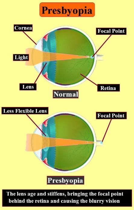 Write a note on eye defects and their correction.