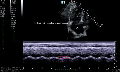 Tricuspid Annular Plane Systolic Excursion (TAPSE) in a Patient with Pulmonary Emboli - JETem