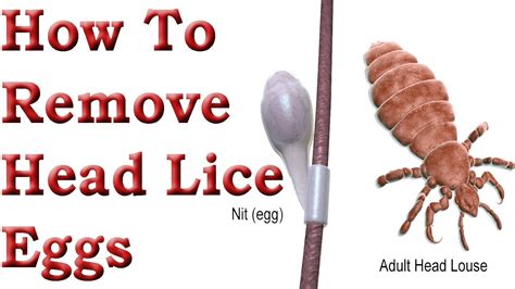 How To Remove Head Lice Eggs - Head Lice Treatment - YouTube