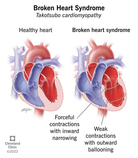 Can Anxiety Take A Toll On Your Heart Health?