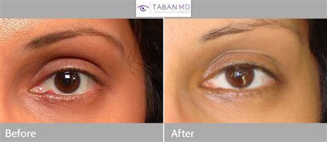 Eyelid Chalazion Surgery Before and After Gallery | Taban MD
