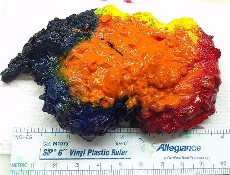 Breast grossing - Libre Pathology