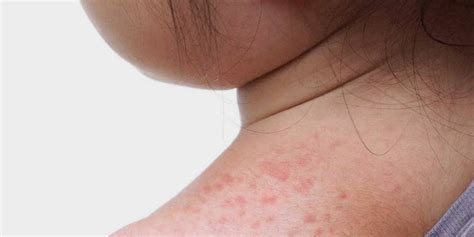 Suffering From Sweat Rashes? These Home Remedies Will Cure & Soothe You!-Suffering From Sweat ...