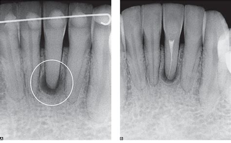 Figure 5 from metamorphosis and aseptic necrosis of the | Semantic Scholar